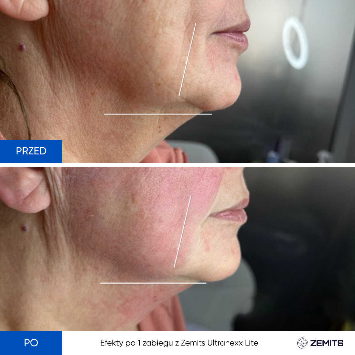 Before After Slide 5