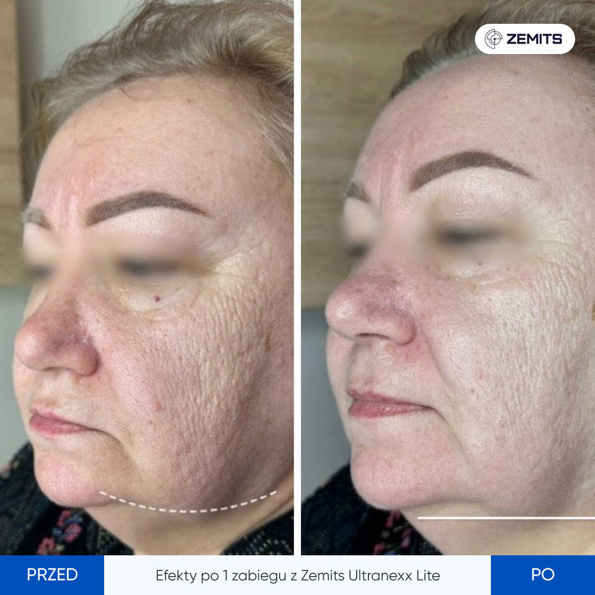 Before After Slide 6