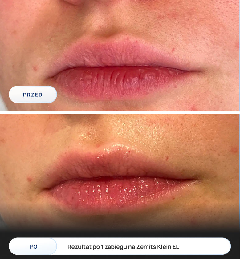 Before After Slide 1