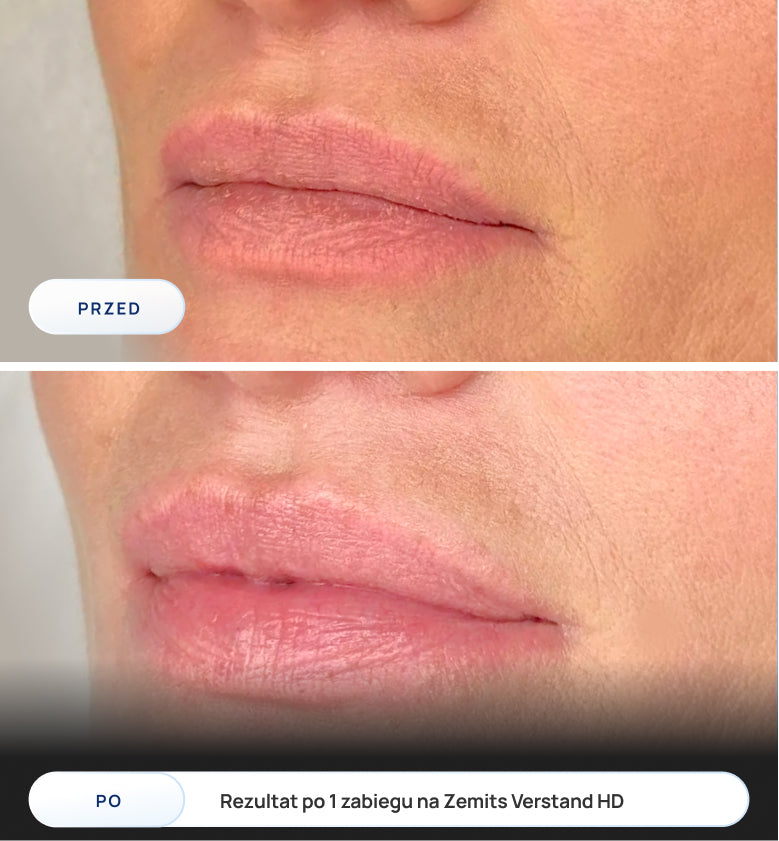 Before After Slide 3